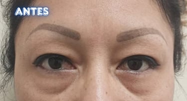Dra. Lilyan Marissel - Cirugía Plástica y Estética - blefaroplastia-mujer-bolsas