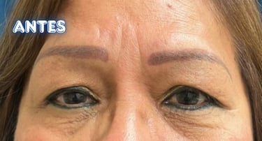 Dra. Lilyan Marissel - Cirugía Plástica y Estética - blefaroplastia-mujer