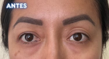 Dra. Lilyan Marissel - Cirugía Plástica y Estética - blefaroplastia-transconjuntival-mujer-bolsas