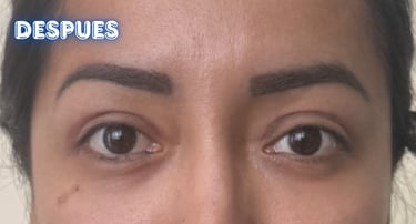 Dra. Lilyan Marissel - Cirugía Plástica y Estética - blefaroplastia-transconjuntival-mujer-bolsas