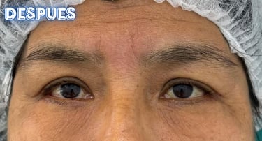 Dra.LilyanMarissel-Cirugía Plástica-Estética - blefaroplastia-mejores-resultados-naturales