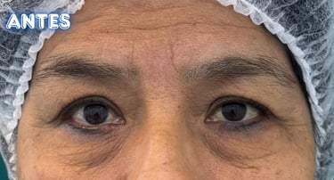 Dra.LilyanMarissel-Cirugía Plástica-Estética - blefaroplastia-mejores-resultados-naturales