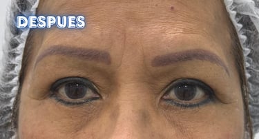 Dra. Lilyan Marissel - Cirugía Plástica y Estética - blefaroplastia-mujer