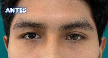 Dra.LilyanMarissel-Cirugía Plástica-Estética - blefaroplastia-simetrizacion-resultados-naturales