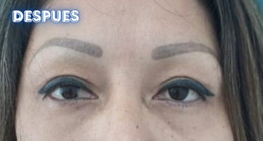 Dra. Lilyan Marissel - Cirugía Plástica y Estética - blefaroplastia-mujer-bolsas