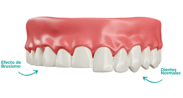 Tratamientos para el bruxismo en  las palmas de Gran Canaria