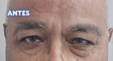 Dra. Lilyan Marissel - Cirugía Plástica y Estética - blefaroplastia-varon-bolsas