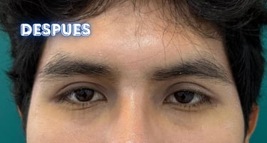 Dra.LilyanMarissel-Cirugía Plástica-Estética - blefaroplastia-simetrizacion-resultados-naturales