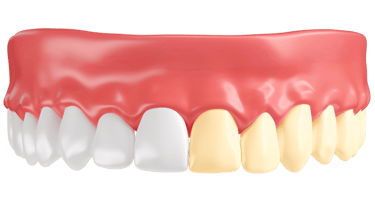 blanqueamiento dental desde 90 euros en las palmas de gran canaria