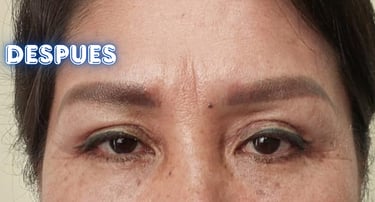 Dra. Lilyan Marissel - Cirugía Plástica y Estética - blefaroplastia-mujer