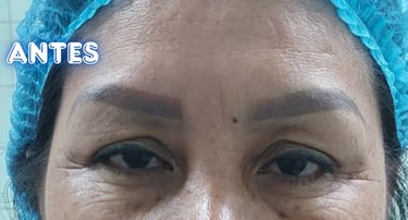 Dra. Lilyan Marissel - Cirugía Plástica y Estética - blefaroplastia-mujer