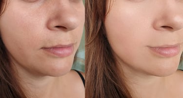 Botox Before and After