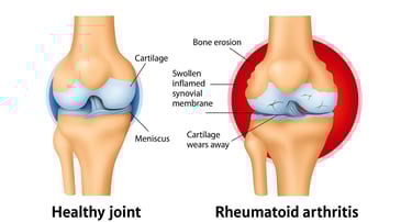 Diagram showing rheumatoid arthritis on knee joint- before and after causing RA.