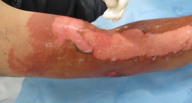 burn wound