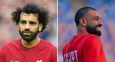 زراعة الشعر محمد صلاح