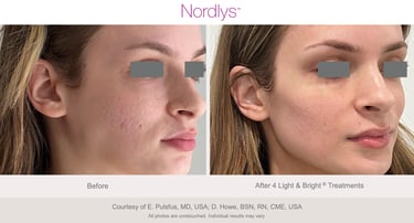 esthetician performing acne and congestion treatment for healthy skin in Hamilton clinic