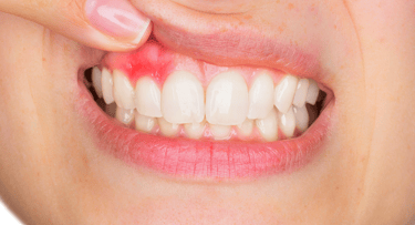 healthy dental gum or gingiva care