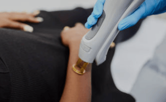 laser arm treatment