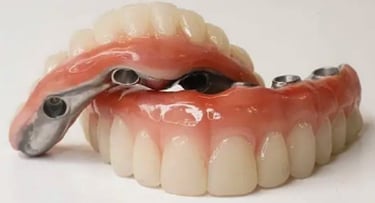 Fixed bridge wih titanium bar supported by implants