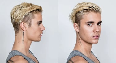 justin bieber hair transplant