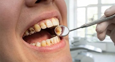 Taches sur les dents hygiene-precision.com