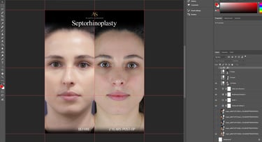 Photoshop workspace showing the creation of a branded septorhinoplasty before-and-after template