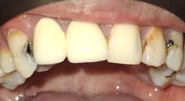 before rct showing severe carious upper front teeth at shree dental care