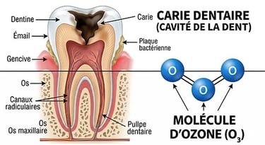 Ozonothérapie et carie dentaire