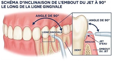 Technique d'utilisation d'un jet dentaire sur la gencive enflammée
