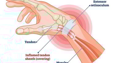 Dr.Rajinikanth's ortho clinic de quirvain's disease