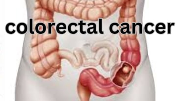 colorectal cancer