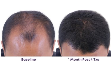 bald man rejuvenated by Alma TED hair treatment within 4 treatments