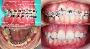 Benefits of Braces — Verified by Leading Orthodontic Associations Worldwide
