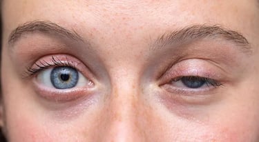 Correção de Ptose Palpebral - Dra Luisa Gross