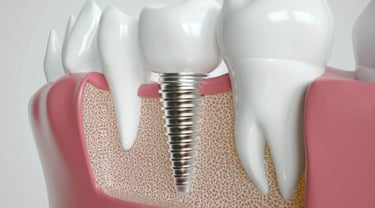 Cosmedic Express clinics in Turkey/Albania perform Dental Implants and Cosmetic Dentistry