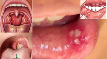 throat inflamtion