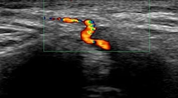 vascular ultrasound artery temporal facial parietal giant cell arteritis pain face vision jaw symptoms polymyalgia rheumatica