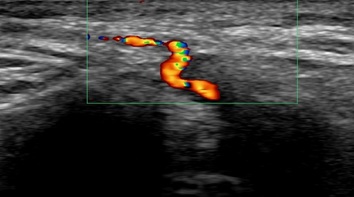vascular ultrasound artery temporal facial parietal giant cell arteritis pain face vision jaw symptoms polymyalgia rheumatica