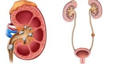 Causes and Prevention of Kidney Stones, Impacted  
