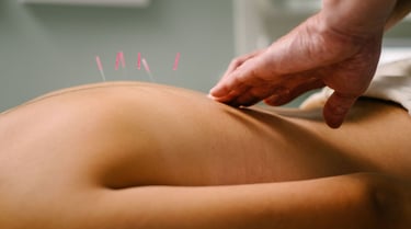 Professional acupuncture treatment showing needles in a patient's back for holistic pain relief.