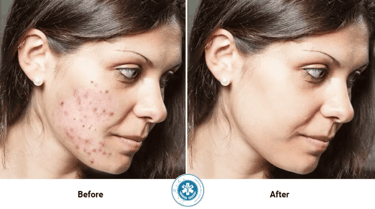 Severe Acne