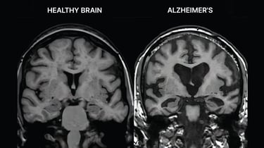 image montant un cerveau sain et un atteint par Alzheimer