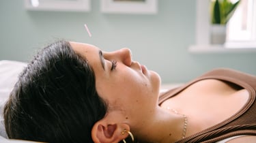 A woman receiving a facial acupuncture treatment with a needle inserted in her forehead for holistic wellness.