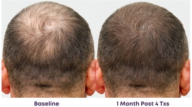 noticeable thicker and fuller hair with less bald spots after 4 treatments