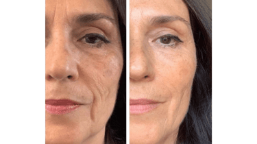 Elixir da Beleza 01- Skinbooster 