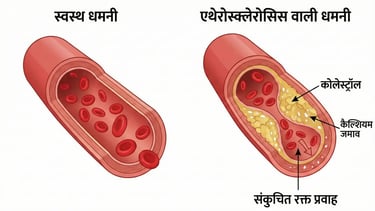 Medical illustration showing cross-section of healthy artery vs artery with plaque buildup.