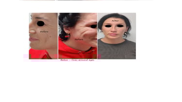 Before & after photos botox around eye – fresher, more appealing and youthful appearance.