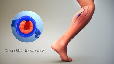 vascular ultrasound blood clot deep vein thrombosis leg swelling thinner anticoagulant embolism pain doppler factor v leiden