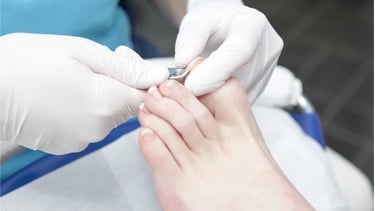 Layanan Kuku Cantengan Klinik Sehat Plus BSD