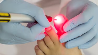 Micose nos pés | Talitha Miquelanti - Podóloga em Uberlândia | Podologia em Uberlândia